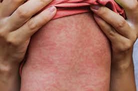 Waspada Campak Saat Lebaran Dinkes DKI Ingatkan Hindari Mencium Bayi Saat Silaturahmi