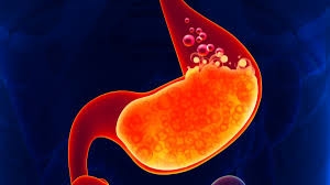 Mudik Tenang Tanpa Drama Asam Lambung, Begini Cara Cegah GERD Kambuh di Perjalanan