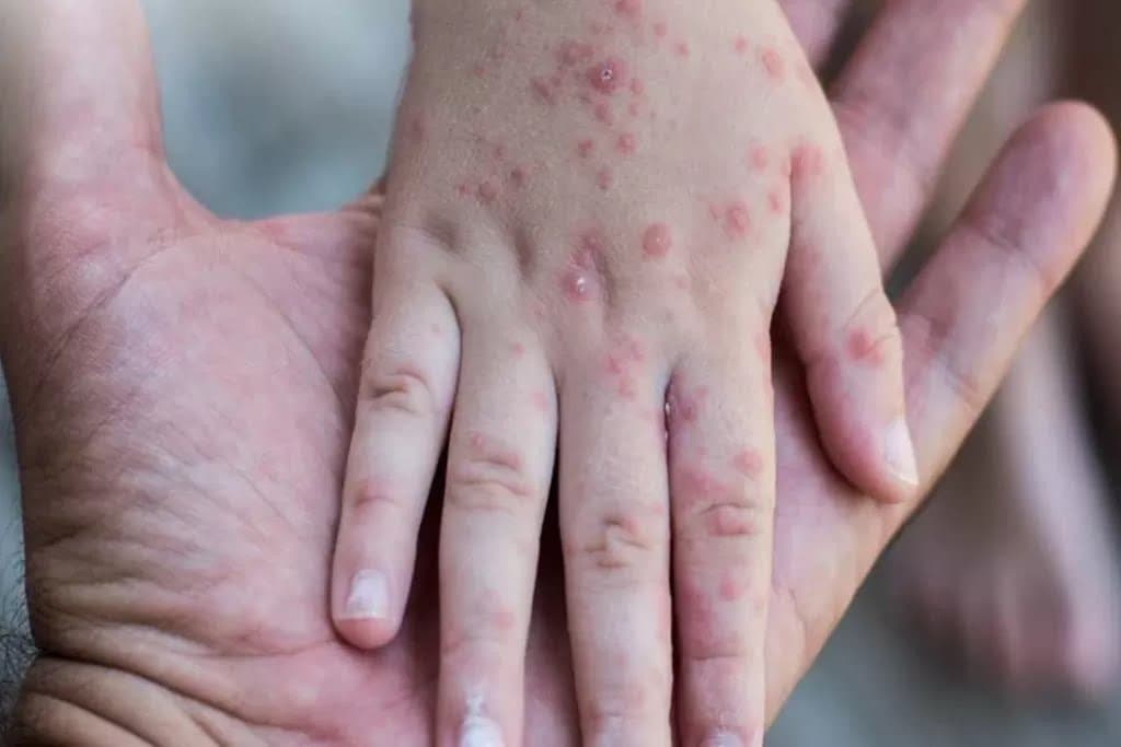 Mengejutkan Campak Ternyata Jauh Lebih Menular dari COVID-19, Kasusnya Kembali Meningkat di Indonesia