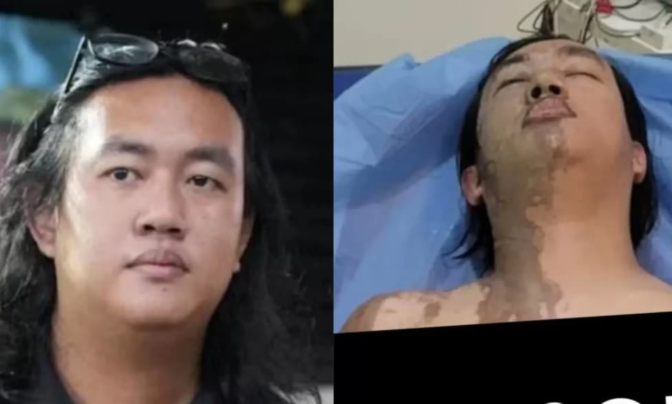 Terungkap Kondisi Andrie Yunus di RSCM Masih Kritis, Komnas HAM Beberkan Fakta Mengejutkan