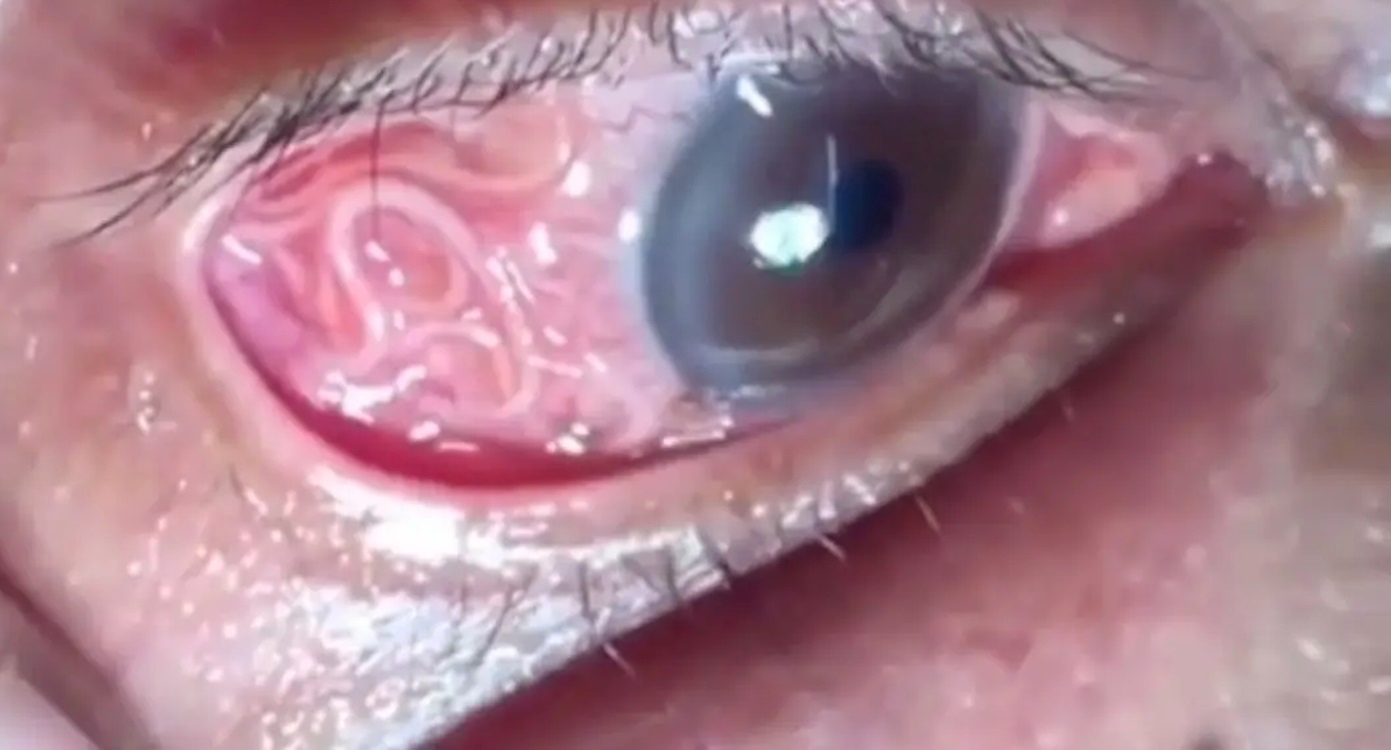 Gatal? Mungkin Kelopak Mata Sudah Bersarang Cacing, Kenali Tanda Dan Gejalanya!