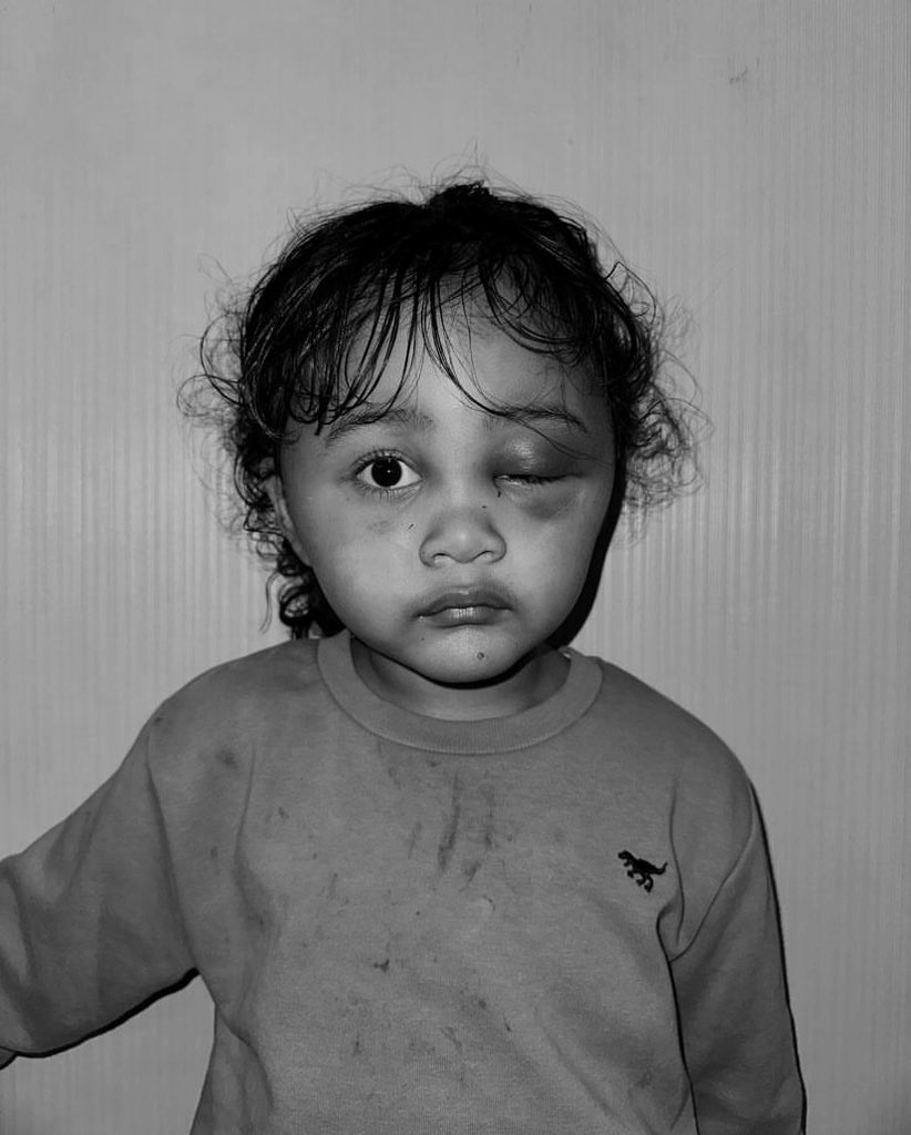 Anak Selebgram Emy Aghnia Dianiaya Suster, Wajah Lebam Parah