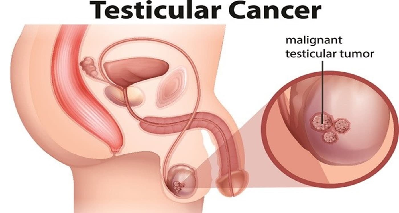 Heboh! Akibat Kanker Kelamin 4000 Meninggal, Setiap Hari 2 Orang Pria Kehilangan Alat Vitalnya di Amputasi