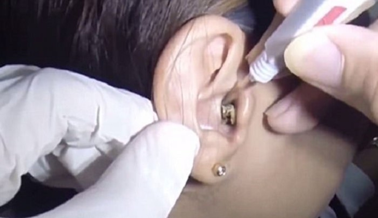 Tips Dokter! Gegara Video Viral di Lubang Telinga Wanita Tangsel, Bersarang Jamur Mengerikan Hingga 2 Bulan Lebih