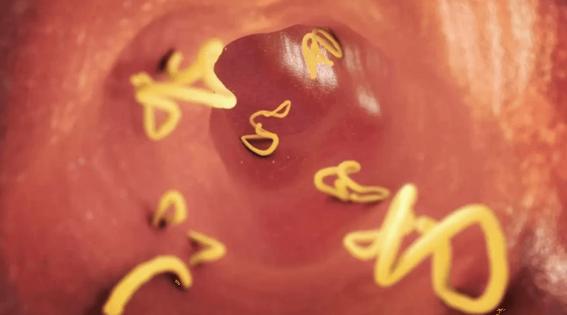 Terungkap Fakta Raya Tubuhnya Dipenuhi Cacing sampai ke Otak, Kemenkes Buka Suara